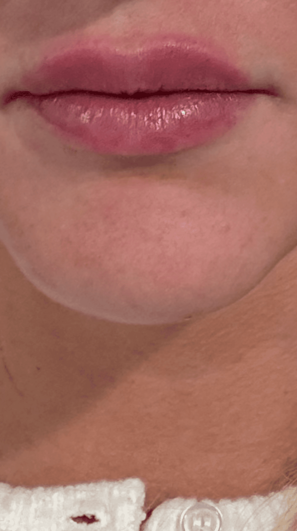 Lip Filler - After
