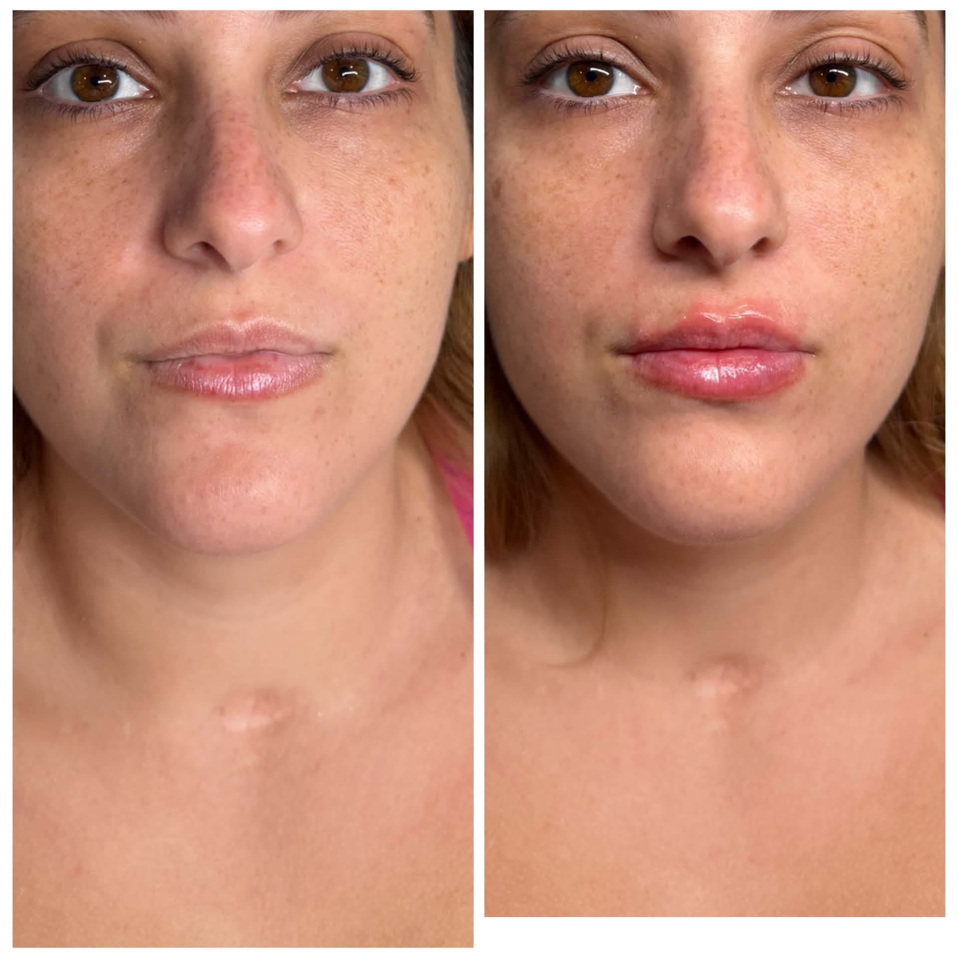 Botox before and after at Ariava Medical Aesthetics
