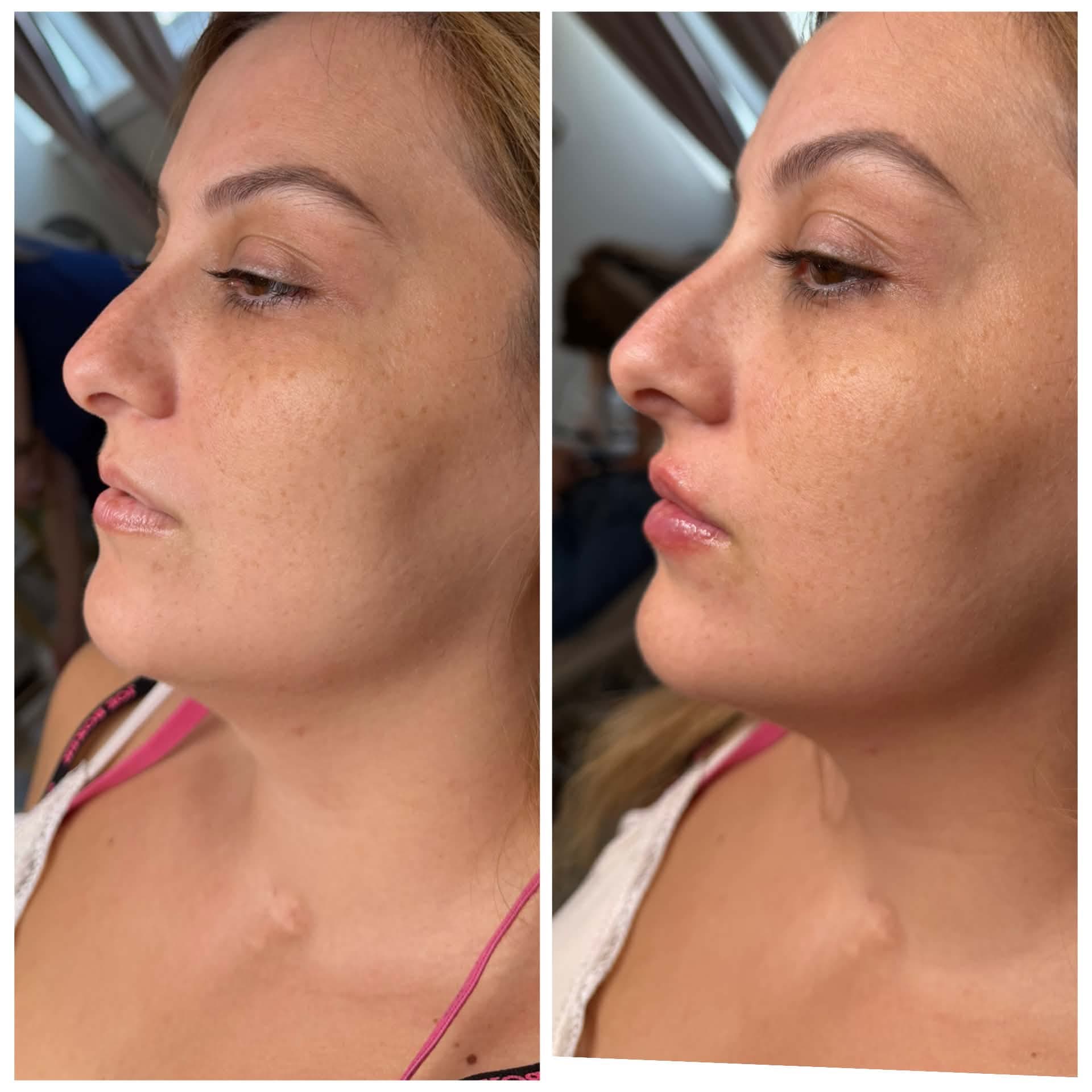 Botox before and after at Ariava Medical Aesthetics