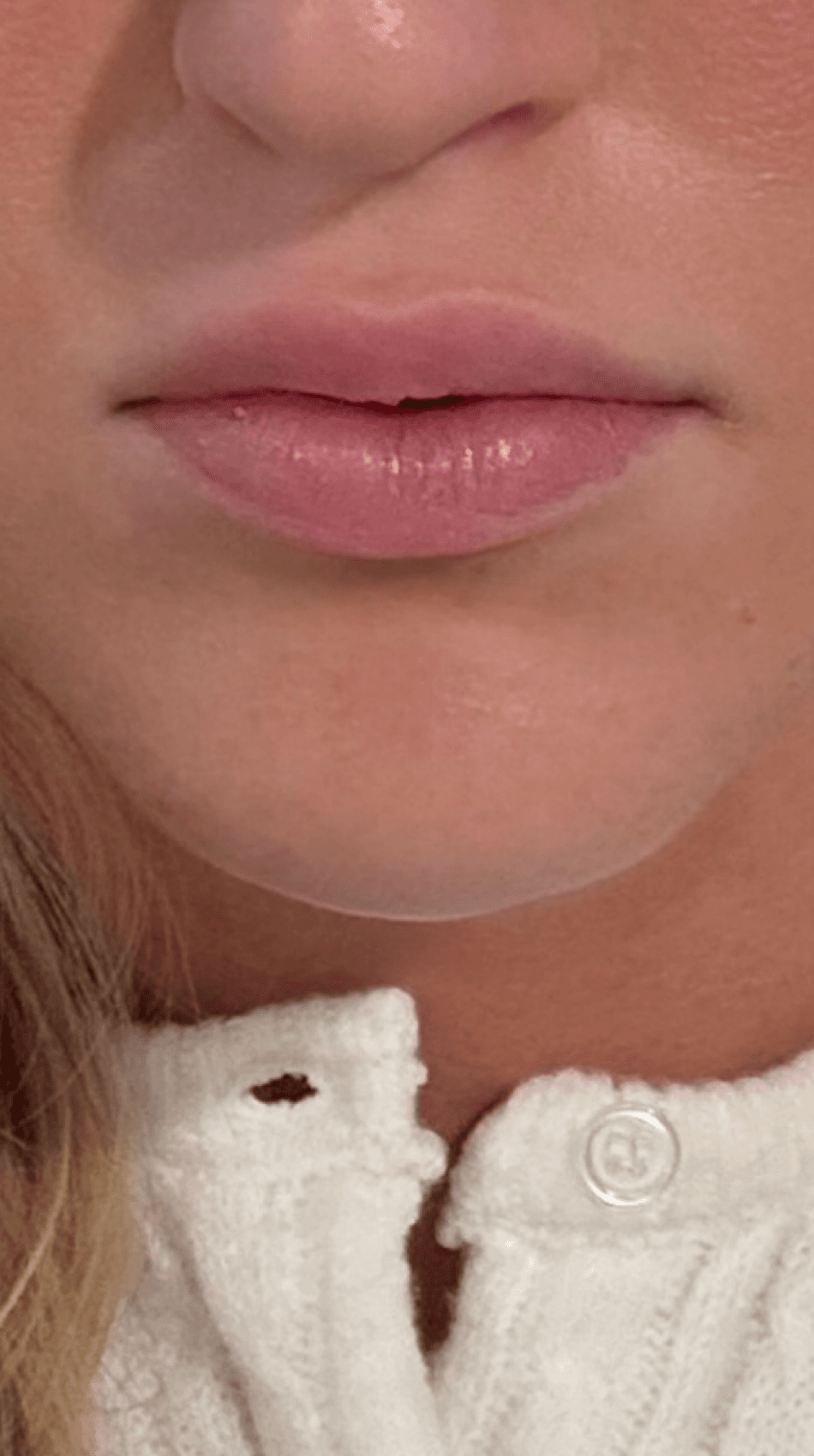 Lip Filler - Before