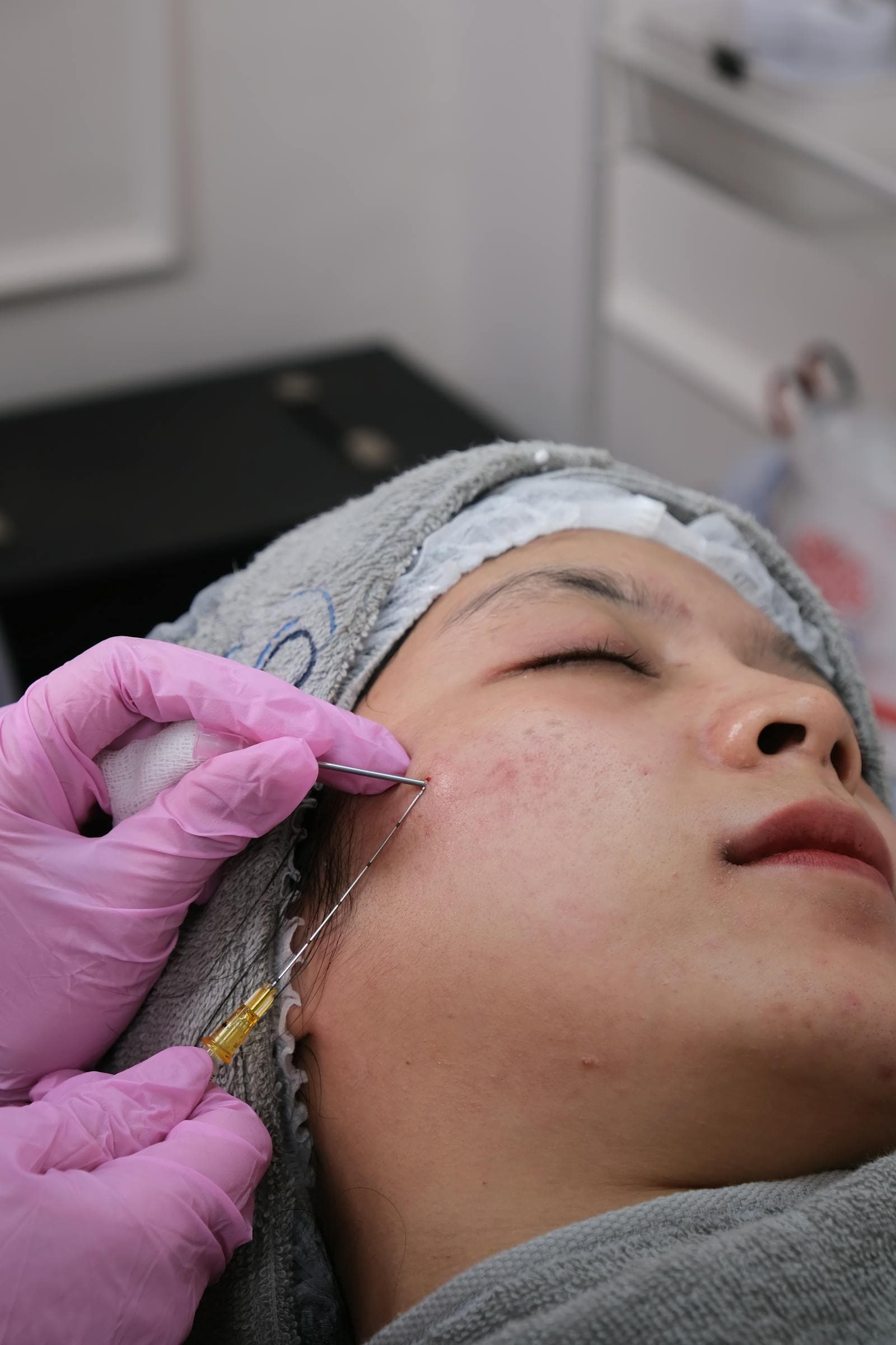 Microneedling at Ariava Medical Aesthetics